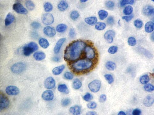 IHC of Epstein Barr Virus on an FFPE Hodgkin’s Lymphoma Tissue